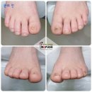 레푸스 수락산역점 | [노원] 문제성발톱 스케일링 후기 ‘레푸스 수락산역점' | 노원 무좀발톱 내성발톱 | 관리 전후 사진...