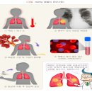 세균성 폐렴 이미지