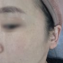 2 | [내돈내산/피부과] 포텐자·리쥬란 2cc·팔뚝주사 후기