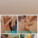 귀건강이혈테라피 이미지