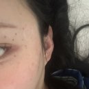 영등포종도외과의원 | 서울 편평사마귀 제거 레이저 말고 수기치료로 일주일 만에 싹 없앤 후기 (내돈내산, 가격 공유)