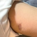 1년 반에 걸친 서울 흉터치료 전문병원 나음피부과의원 구본철 선생님 10회 내돈내산