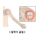 팔죽지 골절 (Humerus fracture) 이미지