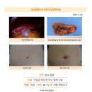 담낭용종수술후기. 건강검진을 마치고 담낭에 용종이 1.3cm 가 있다는 이야기를 들었을 때... 이미지