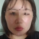 엔디어트의원 | 압구정 피부과에서 온다 리프팅 받고 온 솔직 후기
