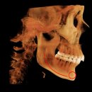 신경선 | 신경선이 낮아 윤곽수술 불가한 분들을 위한 신경보존윤곽수술