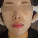 분당-5 | [보나트페이스 분당점] 이매동 작은얼굴 관리 5회차 후기
