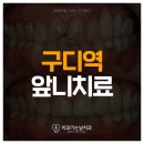 심포니치과기공소 | 구디역앞니치료 깨지고 썩은 앞니, 예쁘게 치료하기 위해서는