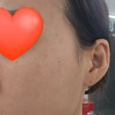 청라잡티제거 디어브로우&amp;셀핏바디피부 잡티지우개 후기