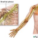 상완신경총 마비(brachial plexus injuries) 이미지