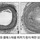 혈전이 뭉쳐져 혈관 차단 죽상혈전증은 '시한폭탄' 이미지