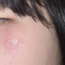 익산 바로그의원 비립종 제거 후기(위치, 주차, 가격, 시술과정)