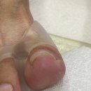레푸스인하대역점 내성발톱 무좀발톱 발각질 문제성발 이미지