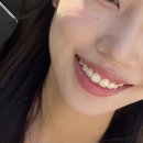 (주)미백 | 강남 레브치과 치아미백 원데이 2주차 찐후기 내돈내산