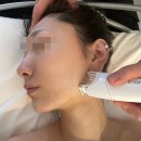 가인 | 청담 가인미가 엔더몰로지 효과 시술 후기