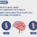 겨울이면 부쩍 늘어나는 뇌졸중! 추위 보다 ‘이것’ 영향이 크다는데 이미지