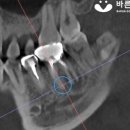 &#34;어금니 잇몸이 자꾸 부어서 아파요!&#34; 아라동 치과 부분 임플란트 수술 후기