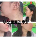 센텀시티역 | 부산해운대 센텀시티역 피부과 이중턱 울쎄라 내돈내산 후기