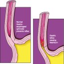 What is oesophagitis? 이미지