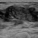 박근준유외과의원 | [부산 유방 외과 전문의 박근준유외과의원] 엽상종