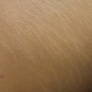 모메피다 | [ 대구 달서구 / 월성동 ] 튼살커버, 두피커버 smp 맛집 -모메피다-