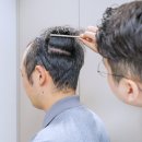 건강369의원 | 정수리 모발이식 잘하는곳 찾는다면