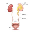 어떤 결석? 신장결석 · 요관결석 · 방광결석 이미지