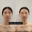 아벨라뷰티 - 도봉구 | 대전 아벨라뷰티 후기로 증명하는 얼굴 사이즈의 드라마틱한 변화