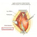 갑상선암 수술 후 목소리 변화 이미지