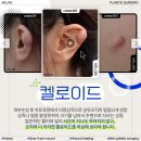 대구켈로이드 치료, 재발까지 고려한 맞춤 수술