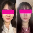 Botem(보탬) | 보탬큐브 프로페셔널 피부과 6년차 솔직 사용 후기 / 효과보장 리프팅 레이저 전후비교샷