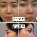 코실리프팅 엘스코 내돈내산 솔직 후기