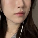 하이펄스 | 여드름 흉터 레이저 울트라펄스알파 내돈내산 전 0회차 | 병원 선택, 가격