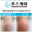 푸스케어대전신탄진점 | 푸스케어 신탄진점 발각질관리 후기