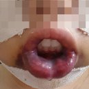 D+6~8 티엘성형외과 안면윤곽3종 내돈주고 받은 성형수술후기2