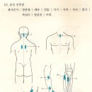 급성인후염 괄사와 벌침으로 치료하기(성인과 어린이포함) 이미지