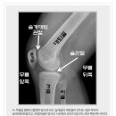 (응용재활)무릎 구부릴때 두두둑 소리가 난다면?(슬개골 연골연화증) 이미지