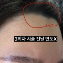 안산 쁨의원 남자수염, 여자 3자이마 레이저제모 1~3회차 변화 후기 내돈내산
