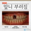 중화다인치과의원 | "앞니 임플란트 티 날까요?" 수유 넘어져서 앞니 부러짐 생생후기