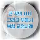 사시월 | [대전 프리즘 안경] 큰 각의 내사시와 수직사시 그리고 부등시가 함께 있었던 복시 사례