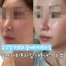 라임 | 압구정피부과 울쎄라피프라임 내돈내산 후기 : 중안부 탄력 관리 7일차
