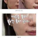 압구정 피부과 모공축소 여드름흉터 패인흉터 E2 레이저 후기