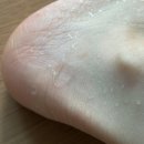 표재성 2도 화상 물집 병원치료 흉터관리 (실비청구 흉터 연고 팁)