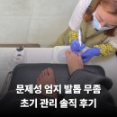 (주)수하나헬스케어 | 전주발톱무좀 여자 엄지 초기 증상 관리 솔직 후기 효자동 문제성 전문 홀드핀칭 네일샵