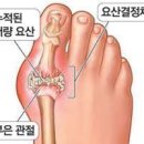 통풍 증상 원인 치료 요산수치 이미지