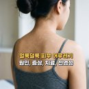 황토피부미용실 | 어루러기 원인과 증상 전염성. 얼룩덜룩한 피부 색소 침착 및 반점 치료법