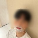 검단 피부과 톤즈의원 젠틀맥스프로플러스 제모 1회차 - 남성 여성