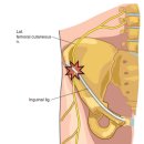 meralgia paresthetica (지각이상성 대퇴신경통) 이미지