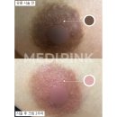 mc메디 | ✨ 당진 메디핑크 멜라닌 케어, 유륜 &amp; 외음부 &amp; 엉덩이 밑 톤 변화 실제 후기 공개 💗