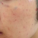 안일약국 | [내돈내산] 피부과 시술 후 멍 주사자국 없애는 약국연고▪️프로캄 레드엑스 크림에스▪️구매후기 |눈가...